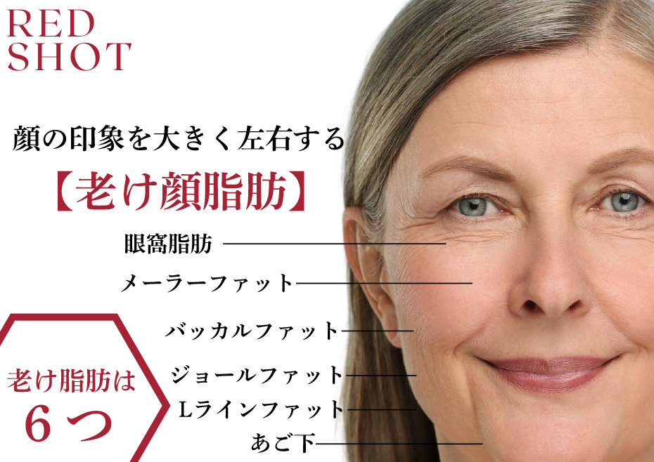 顔の印象を大きく左右する【老け顔脂肪】眼窩脂肪 メーラーファット バッカルファット ジョールファット　Lラインファット　あご下